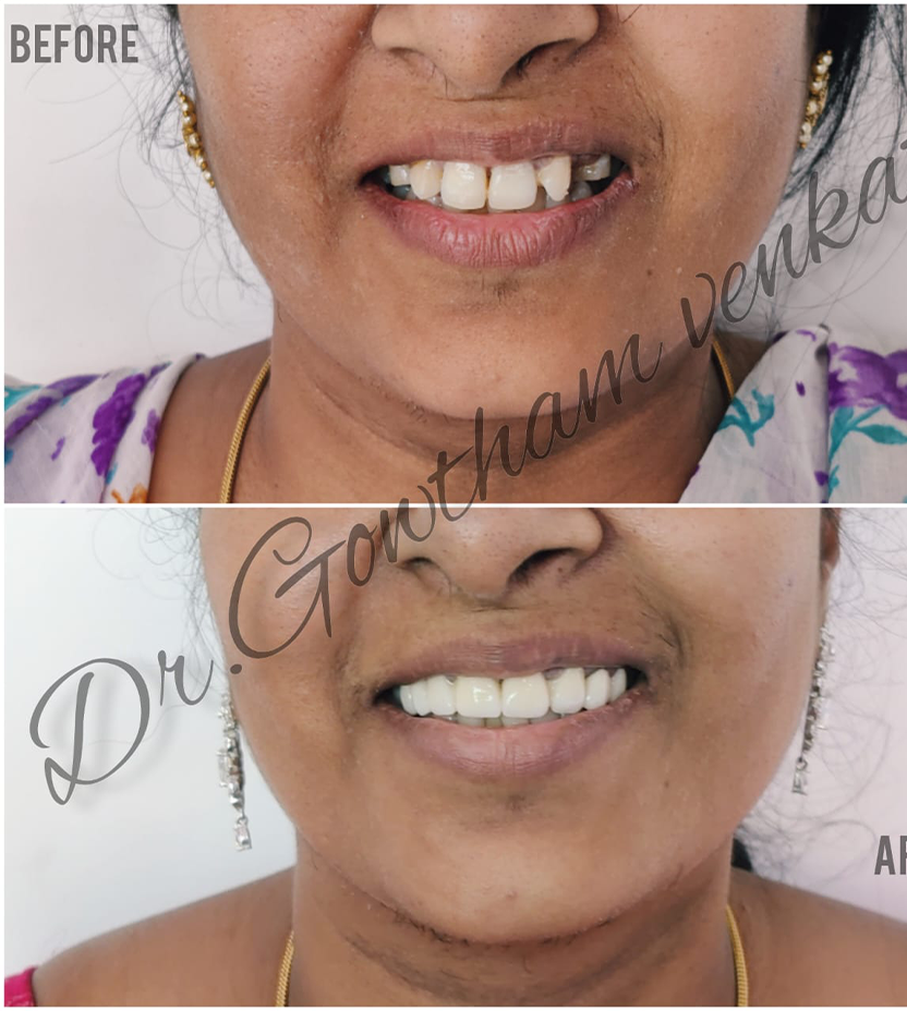 Invisalign in Vadapalani