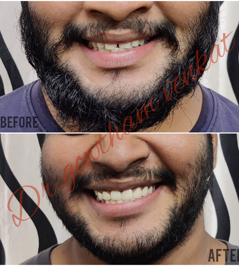 Crowns & Bridges in Vadapalani, Chennai