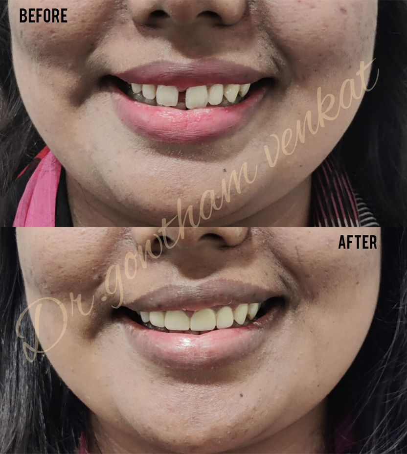 Best Laser Dental Clinic in Vadapalani