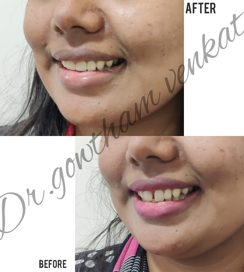 Dental Implants in Vadapalani, Chennai