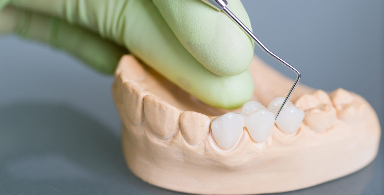 Crowns & Bridges in Vadapalani