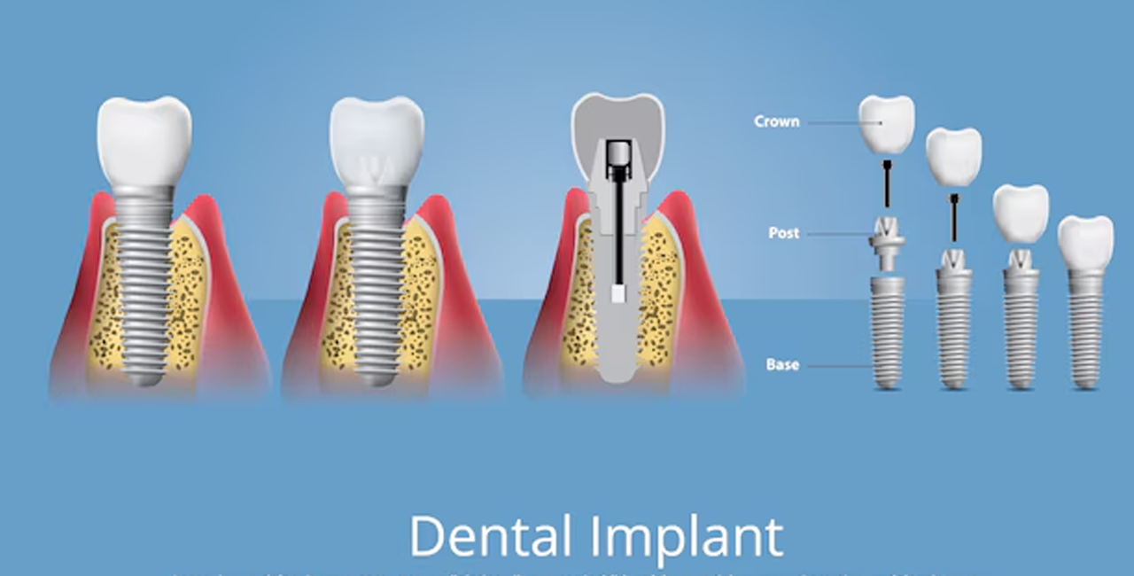 Dental Implants in Vadapalani